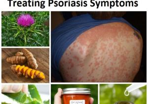 At Home Plan B Remedy 20 Best Home Remedies for Treating Psoriasis Symptoms